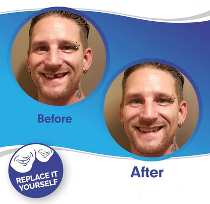 Smile Veneer (Upper & Lower Included)